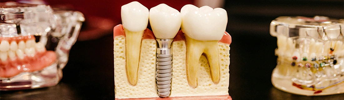 Dental Implants at John R. Striebel Dentistry in Miamisburg, OH – FC